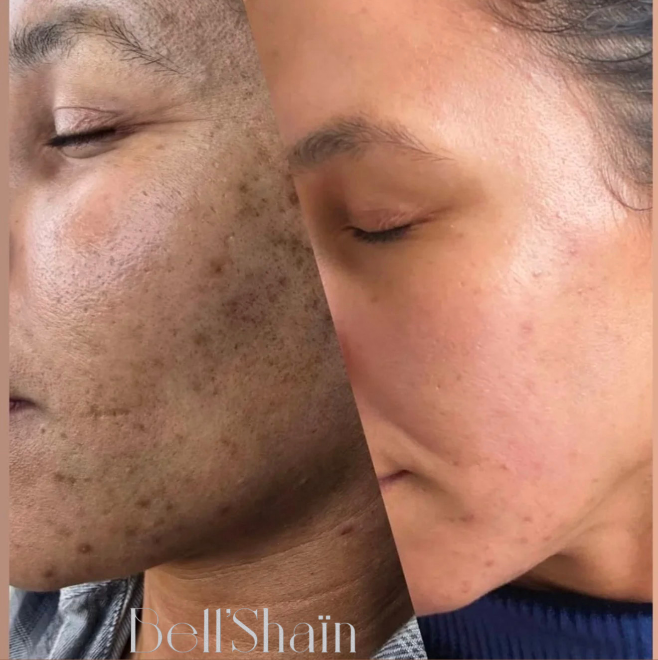 Résultat avant après Bell'Shain Beauty - deux mois de traitement