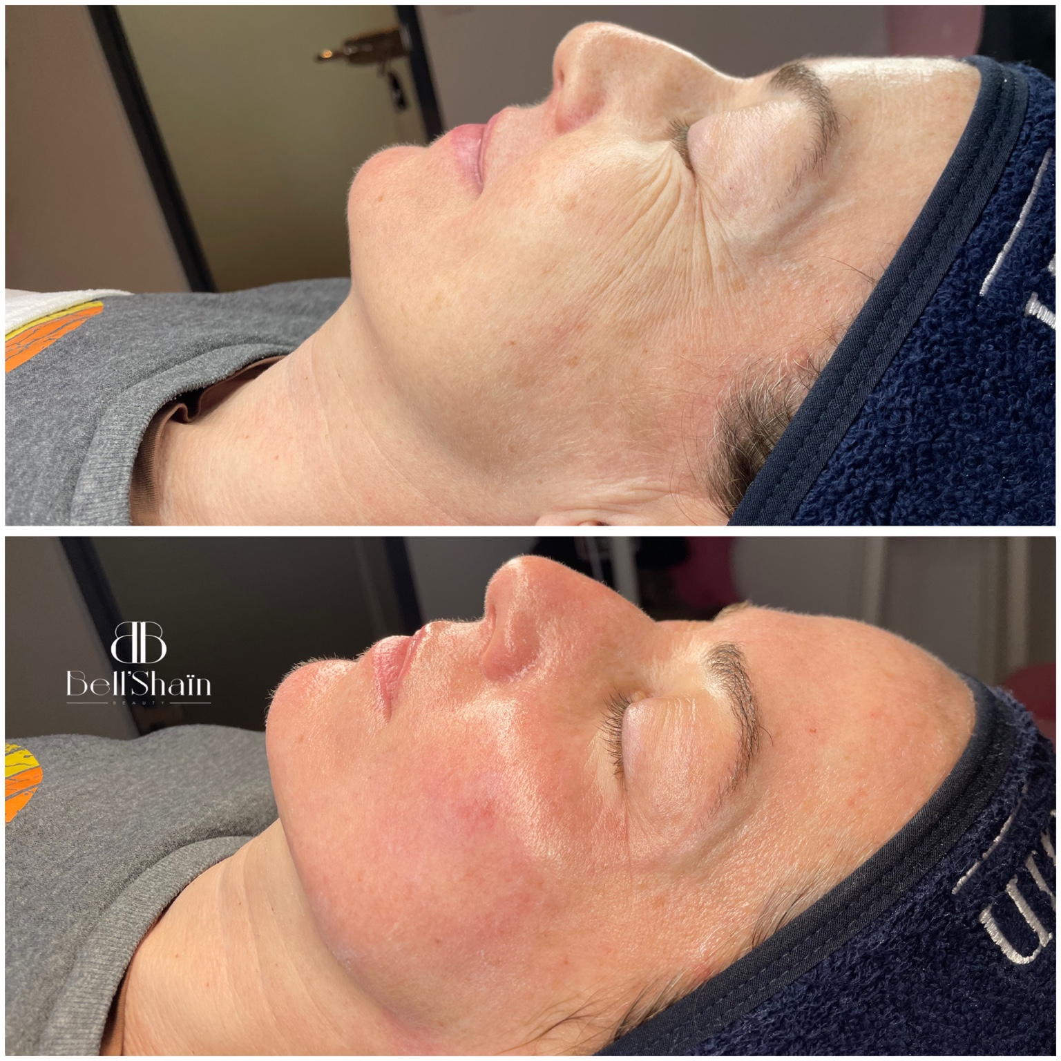 Résultat avant après Bell'Shain Beauty - 1 soin ciblé, 1 séance, 1 heure