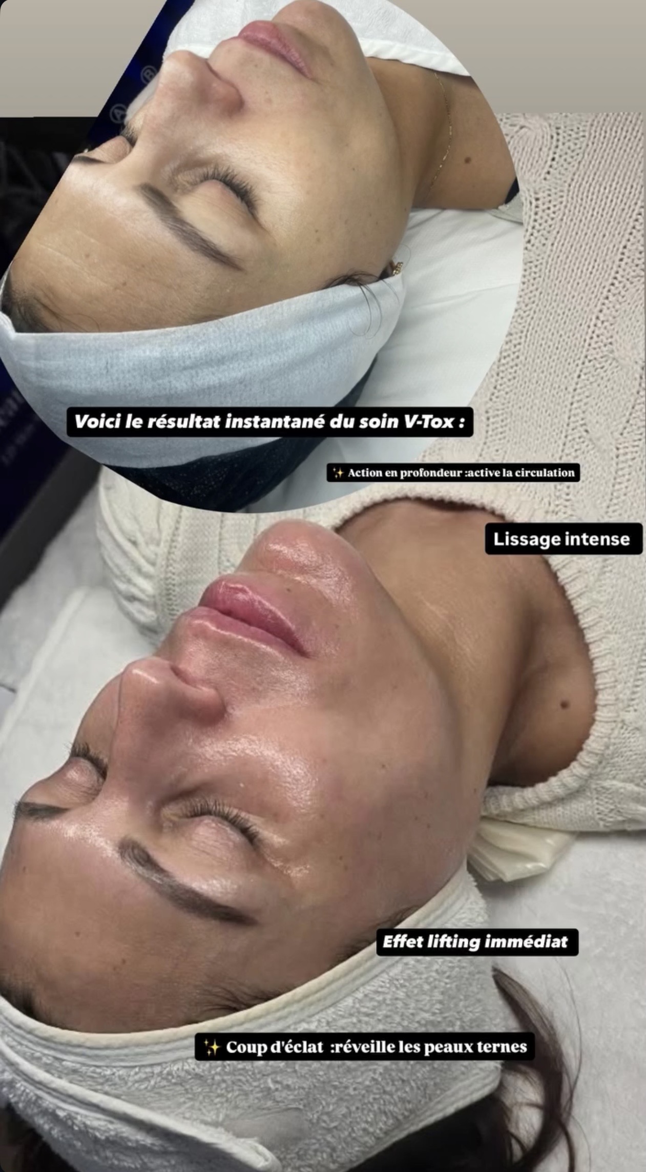 Résultat avant après Bell'Shain Beauty - 1 protocole anti âge, 1 séance, résultats immédiats